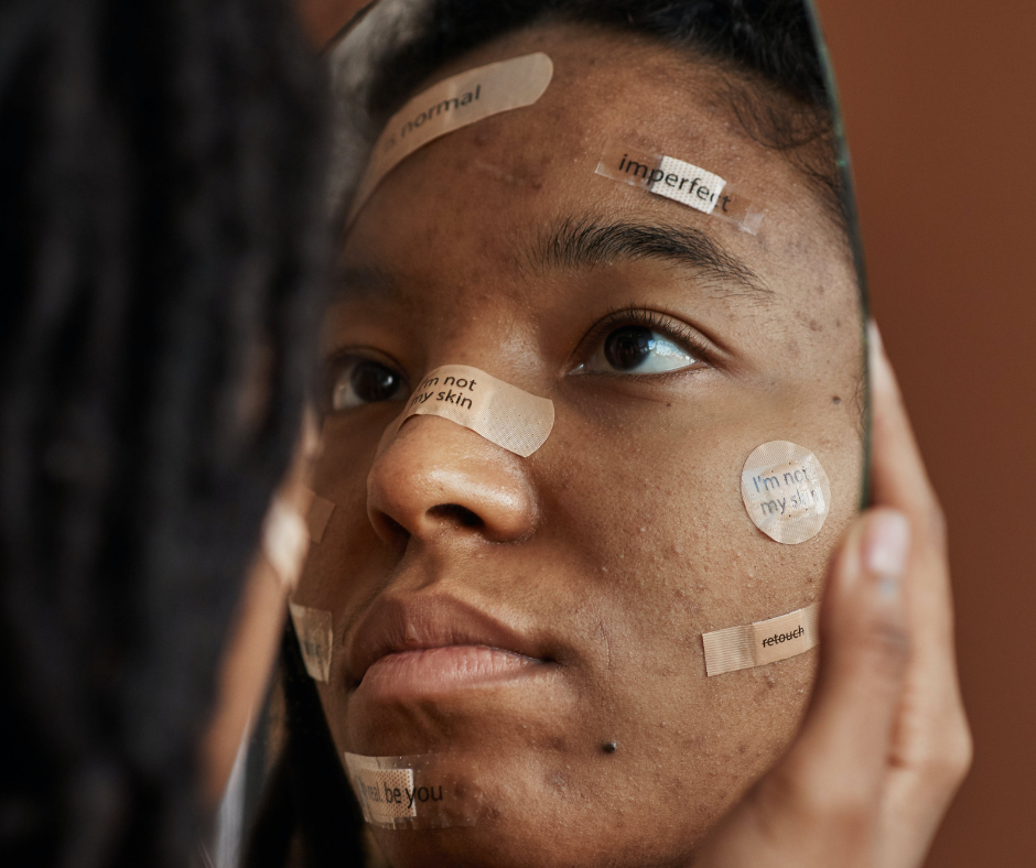 10 Proven Strategies for Tackling Acne in Diverse Skin Tones