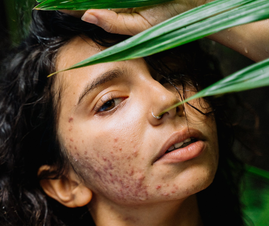 A Latin woman of color with visible acne, depicting the challenges of managing cystic acne in multicultural skin types and highlighting the need for specialized skincare solutions