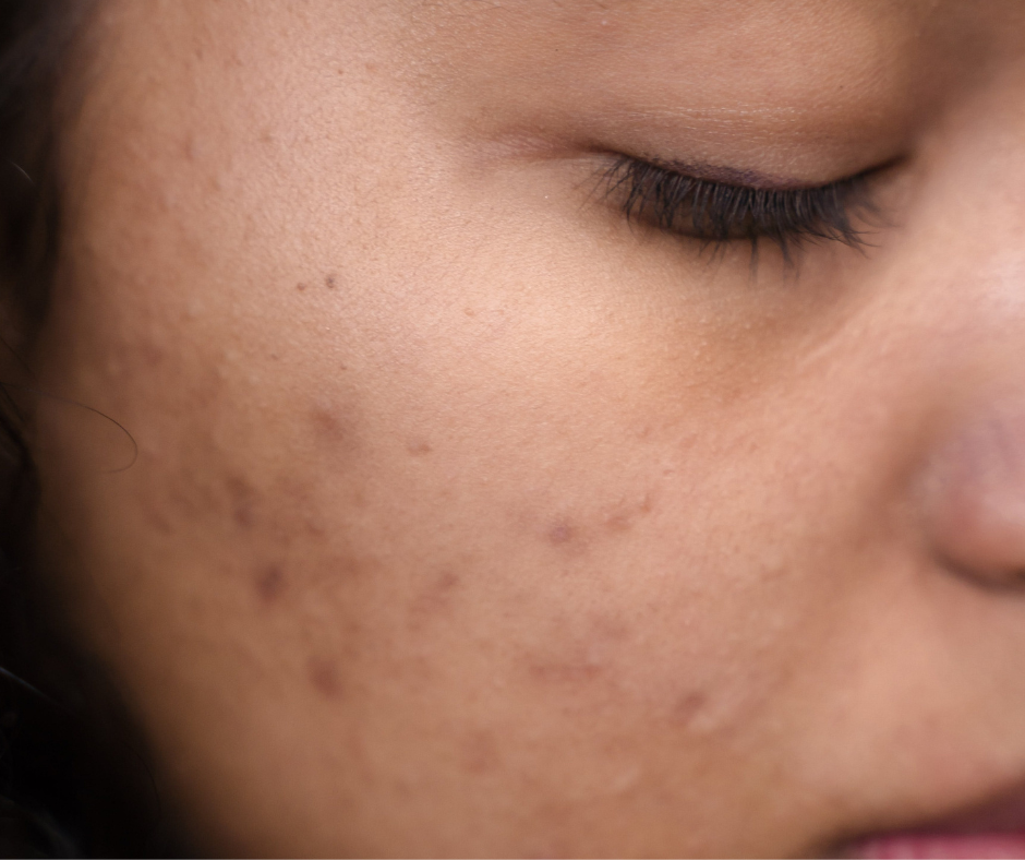 The PCOS & Acne Connection: Understanding and Managing Your Breakouts