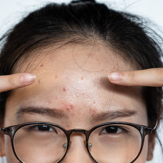 Understanding the Difference Between Acne Breakouts and Fungal Breakouts